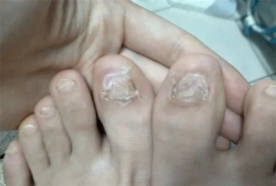 ​女朋友很漂亮但是有灰指甲怎么办